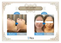 【2回目以降】【小顔✖️美肌マシーン💖4000shot】＋パック付き