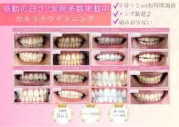 【ミニモSALE】最安値セルフホワイトニング（9分×2セット）¥300⭐︎追加料金なし