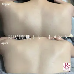 剥離なしハーブピーリング🌿背中上部/背中下部/デコルテ