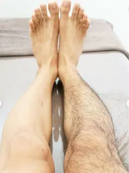 全身脱毛(男性)