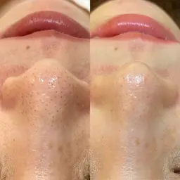 ご新規様限定✨毛穴に特化✨『シェービング&ハイドラフェイシャル』通常¥11,980メニューがこの価格🉐