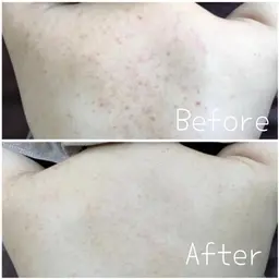 《背中ニキビ/肌質改善/美白/エステ》背中全体ハーブピーリング