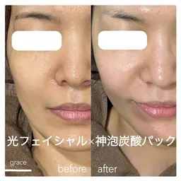 🦢平日限定🦢光フェイシャル🫧神泡炭酸パック付き！ハリツヤ、透明感up！