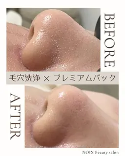 毛穴レス美肌コース🫧洗浄+美容液導入+引き締めパック✨