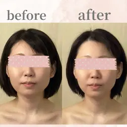 潤いツヤ肌☆憧れ韓国女優肌に♪【コラーゲン産生ラジオ波コース】