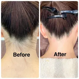 ［うなじMIX脱毛］自分では処理しにくい首元をすっきり整え、後ろ姿まで美しく✨［シュガーリング×光脱毛］