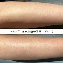 【女性限定】顔+脇脱毛