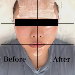 【毎月3名限定✨】美白&小顔リフトアップ超音波エステ🧖