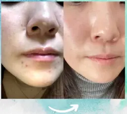 【韓国女優のような陶器肌】❤️つるりん毛穴レス体験❤️［兵庫県尼崎市/痩身エステ］