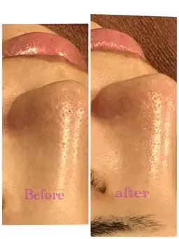 【組み合わせメニュー】より高い美容効果を求める方に！ハイドラ毛穴洗浄+マッサージピール