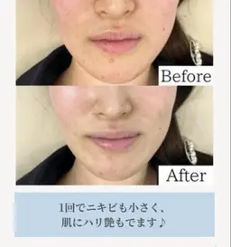 話題の乳酸ピーリング🧖🏻‍♀️🌝✨