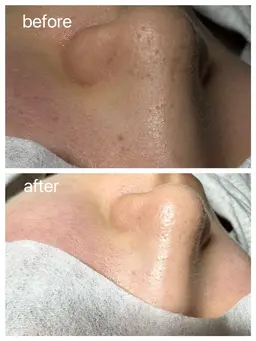 小鼻周り毛穴洗浄×小鼻周りWAX脱毛 🤍🐰 ※月水金は15時にご予約変更する場合あり💦