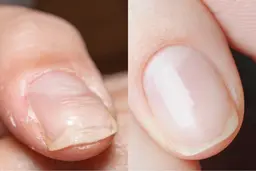 爪の左右サイドの食い込み・鷲爪が気になる方に【陥入爪専用ジェルを使用した自爪育成コース(クリア10本)】ジェルオフなし