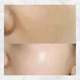 徹底毛穴ケア！うる艶美肌プラズマシャワー+水光ジェット