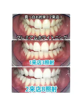 【周りと差がつく白さをお約束✨】白さお約束ホワイトニング❣美しい白さをご体感したい方✨✨〈合計 70分照射 2 来店〉