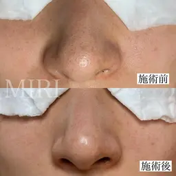 初めての方向け🔰【毛穴ベーシックコース70分】初回カウンセリング込100分