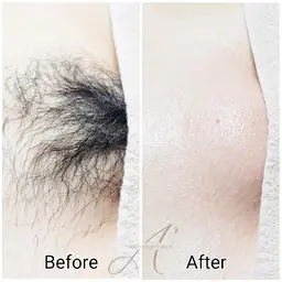 都度払い🍋VIOシュガーリング+全身最新光脱毛