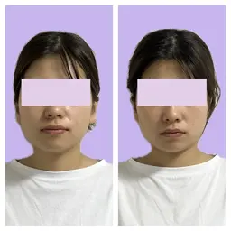 ‼️特別価格‼️小顔美容整骨矯正　　4,500円