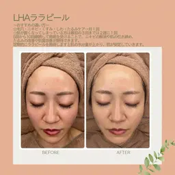 内側から肌を育てるピーリング🌷LHAララピール💚毛穴/ニキビ/くすみ/たるみ/エイジングケア/肌質改善