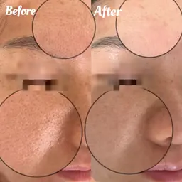 ☆美容皮膚科をサ口ン価額で実現☆シミケア小顔☆最新IPL光フエシャル&毛穴洗浄+デコルテ+イオン導入