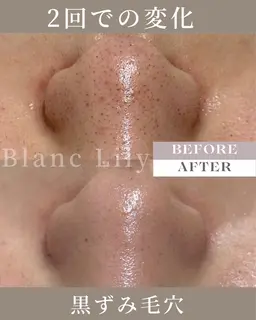 【黒ずみ/ニキビ跡/毛穴】美白ピーリング