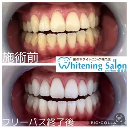 確実に白くしたい★フリーパス3週間通い放題セルフホワイトニングクーポン