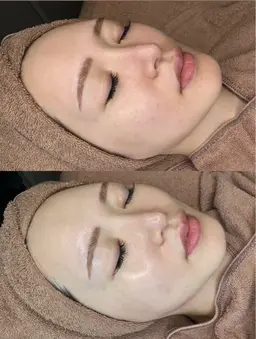 ✨✨️地域最安値✨️✨️ミニモ特別価格🌈練習モデル🍀ララピール★肌を育てる剥離しないピーリング🫧✨全顔施術