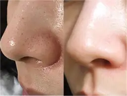 【徹底小顔+毛穴洗浄♪】BUPURA式頭蓋骨小顔矯正+毛穴洗浄