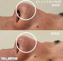 毛穴洗浄。温泉水ベースの専用美容液で優しく古い角質/角栓/皮脂などの汚れを取り除きます★化粧ノリも◎スキンケアの浸透も◎