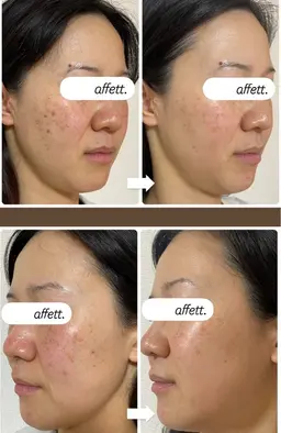 ニキビケアフェイシャル