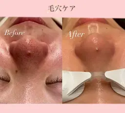 ✨🫧【3月限定】【韓国美肌/毛穴レス】毛穴、角質詰まり改善フェイシャル💆🫧✨