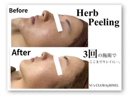 毛穴レス！即質改善ハーブピーリング 60分