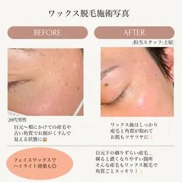眉毛Wax脱毛×お顔のWax脱毛(美肌パック付)