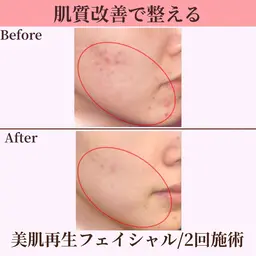【美肌再生フェイシャル】ハリ潤いのある若々しい素肌へ♪繰り返す肌悩み/肌質改善/デコルテ付き《初回限定💫特別価格》