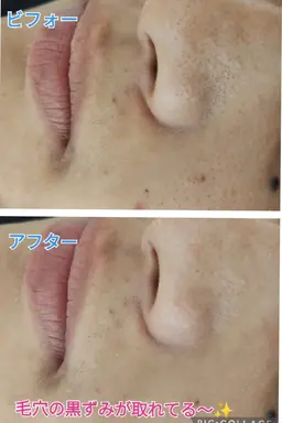 毛穴ケアフェイシャル✨
