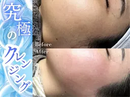 [全顔WAX] シェービングは古い!断然ファイシャルwax(パック付)¥8,800→¥7,500