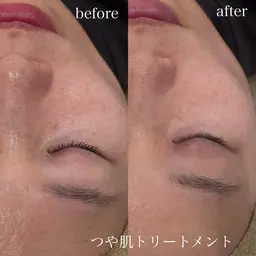 【速攻美肌】つや肌トリートメント