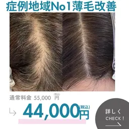 本気の薄毛改善　もう隠さない　頭皮集中改善ケア