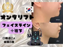 オンダリフト25分｜フェイスライン~顎下80kj~140kj