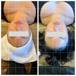 迷ったらこれ!小顔も美肌も手に入れたい方はこちら💁♀️リンパケア、美肌ケアのヒト幹細胞培養液導入エステ