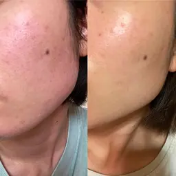 ハイドラ毛穴洗浄+アゼライン酸イオン導入