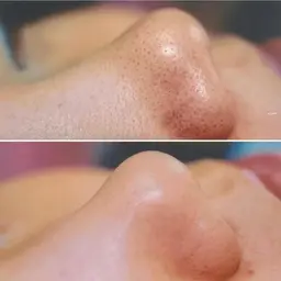 毛穴悩み解消🤍毛穴ケア＋鼻周りワックス脱毛