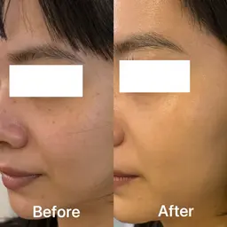 【敏感肌】❤️お試し❤️天然由来100％で安心。鎮静・保湿・再生を叶え1回で透明感・ハリを実感♪￥12000→￥3980