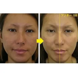 【非対称な顔歪み/下顎,エラ,頬の専門矯正+重心バランス調整】上級MAXコース¥9,980現金限定