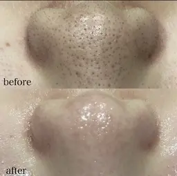 12月特別価格🌟ハイドラ毛穴洗浄+顔脱毛¥13,500→¥6,600