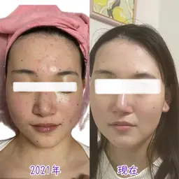 ★顔全体毛穴洗浄とポレーションモードで美容液導入「イオン導入の16倍」ピールオフパック付☀️透明感やもちもち肌希望の方