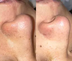 【毛穴詰まり/黒ずみ/開き】韓国式ハイドラ毛穴洗浄＋高保湿パック導入