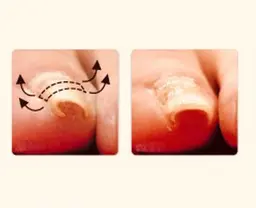 【おすすめ / ご新規 / 再来】#巻き爪 🦶透明プレート足爪1箇所 #肥厚爪 #陥入爪 予防✨