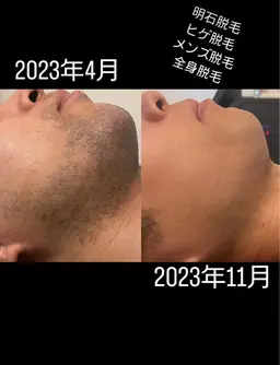 🩵メンズ🩵ヒゲ脱毛