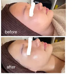 【肌質改善🌿】陶肌トリートメント（剥離なしハーブピーリング）basicコース💋リップトリートメント付